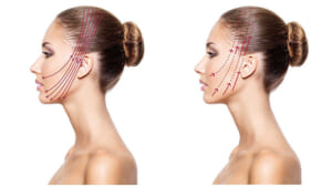 スプリングスレッドの手術の概要と手順