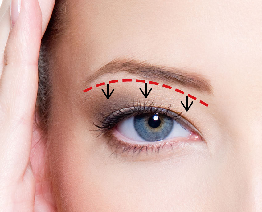 眉下切開（眉下リフト）でまぶたのたるみを治療
