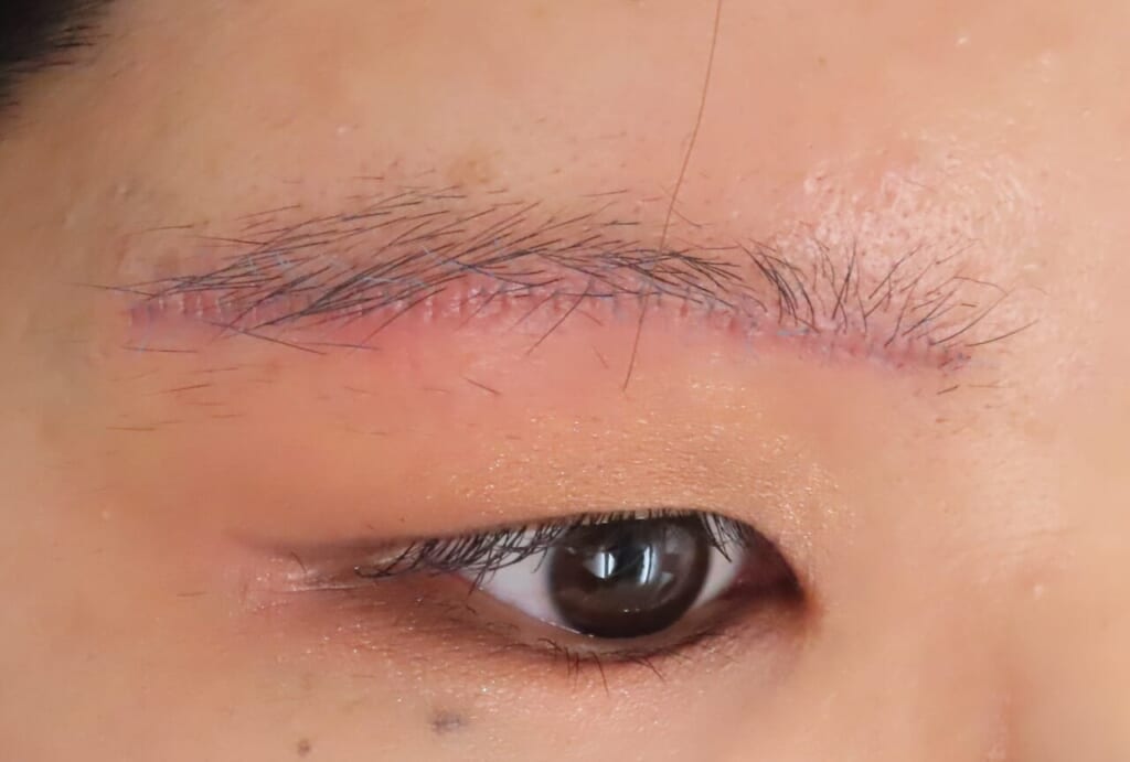 眉下切開後の洗顔はいつから？当日からOKな理由を正直に解説します