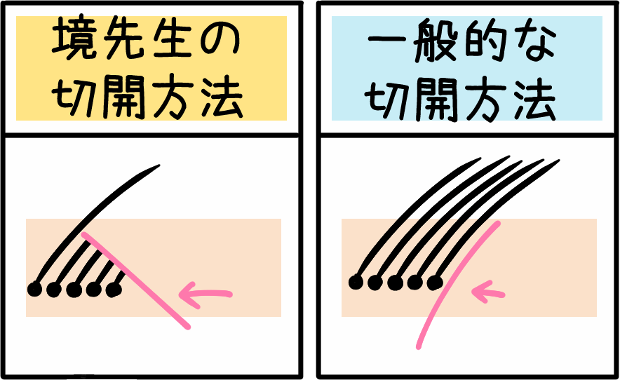 傷跡に毛が生える切開方法のイメージ