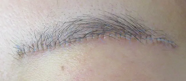 単結節縫合のイメージ